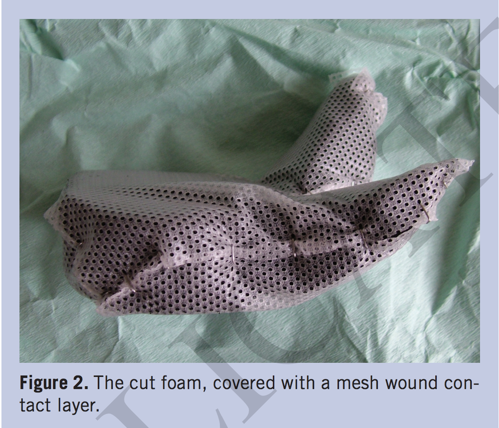 A Simple Method to Prevent VacuumAssisted Closure Sponge Retention in